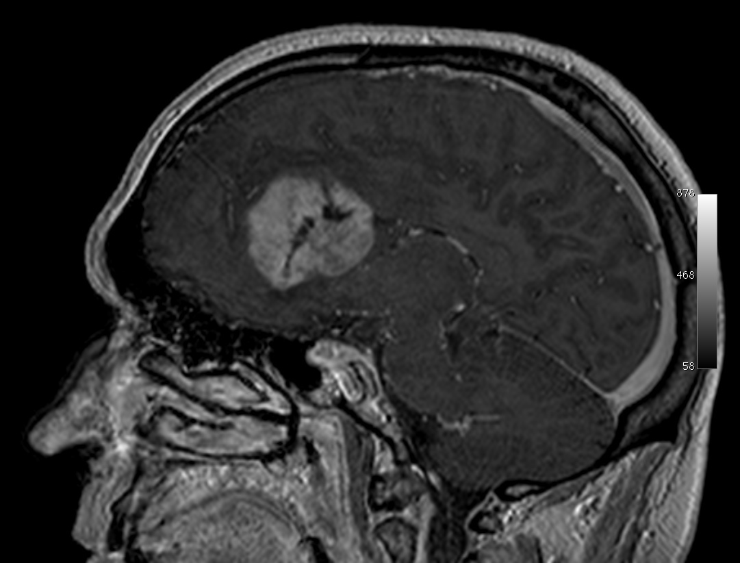 Téléphone et cancer du cerveau : l'emballement médiatique après une étude controversée