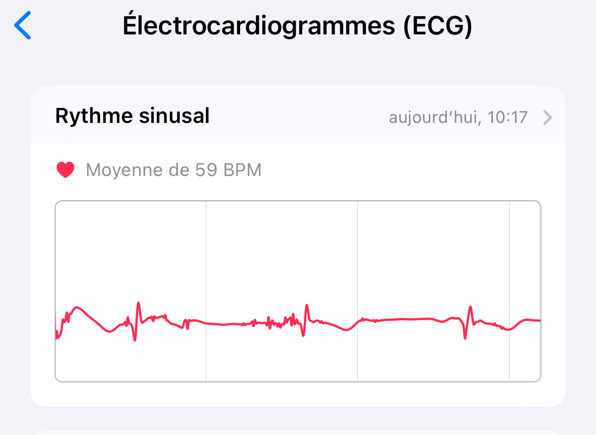 L'Apple Watch présente des données ECG plus lisibles et de meilleure qualité !