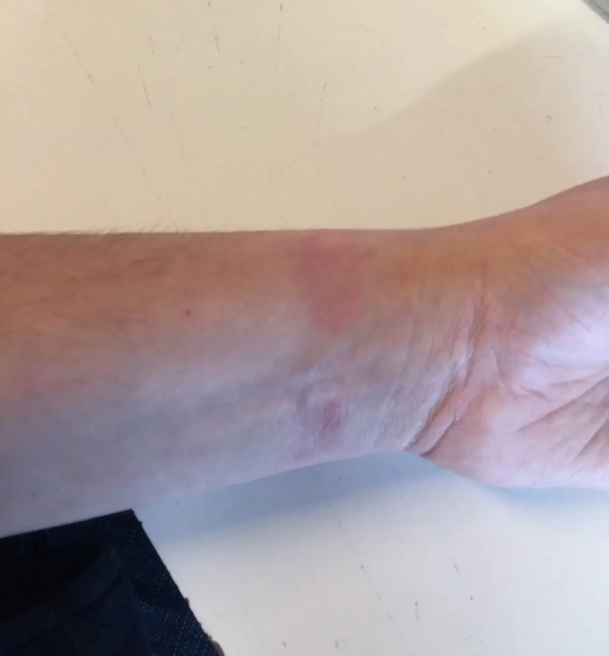 Apple Watchのスポーツブレスレットがアレルギーを引き起こす（写真）