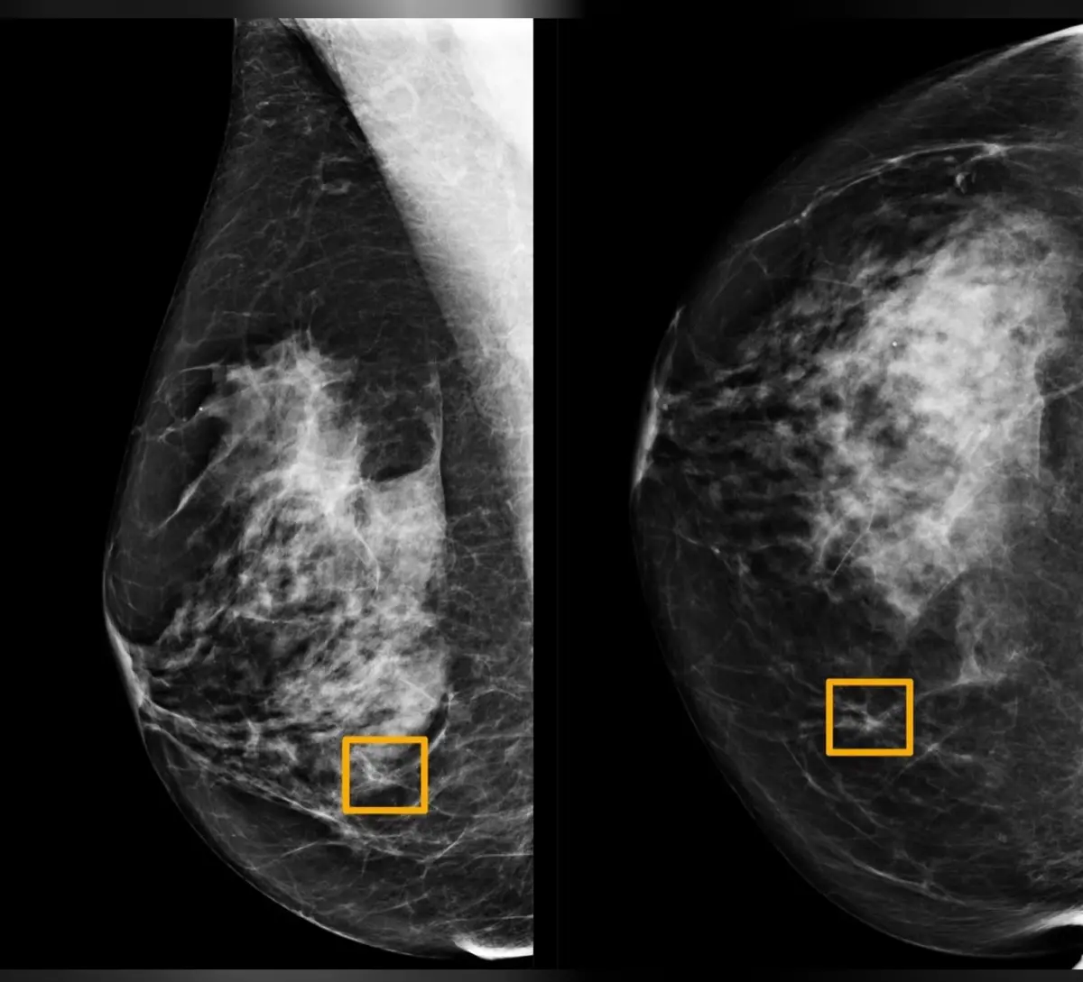 בינה מלאכותית של גוגל מזהה סרטן שד בצורה יעילה יותר מאשר מומחים אנושיים