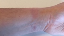 Le bracelet sport de l'Apple Watch causerait des allergies (photos)