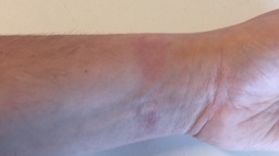 Le bracelet sport de l'Apple Watch causerait des allergies (photos)