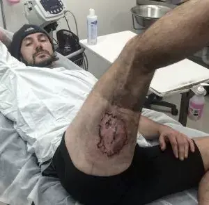 Un cycliste brûlé au 3ème degré par son iPhone 6 après une chute