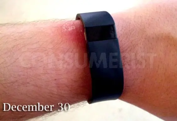 Finalement, Fitbit rappelle ses bracelets "Force" trop "irritants"