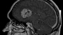 Téléphone et cancer du cerveau : l'emballement médiatique après une étude controversée